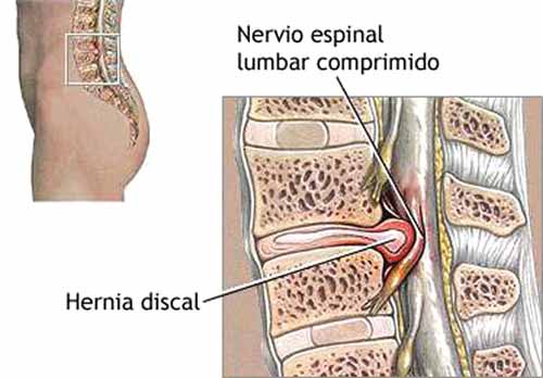 Dolor Cervical y Lumbalgia - Artículos - IntraMed