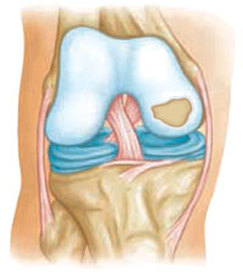 La lesión del cartílago de la rodilla