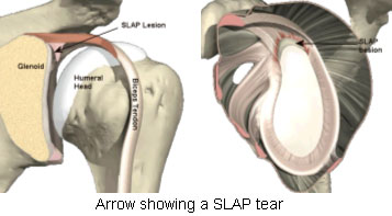  lesión de SLAP 